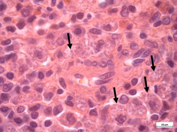 Leishmania parasites in phagocytes in the spleen of VL patient co-infected with HIV
